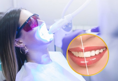 TẨY TRẮNG RĂNG CÓ HẠI KHÔNG?