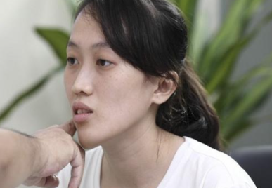 Mặt Lệch Do Đâu? Cách Khắc Phục Và Cải Thiện Nhanh Chóng