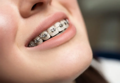 Độ tuổi niềng răng tốt nhất là bao nhiêu?