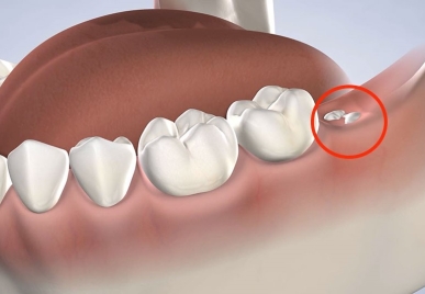 Nhổ răng khôn tại Bà Rịa – Giải pháp an toàn tại Nha Khoa Nhân Đức